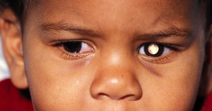 Retinoblastoma